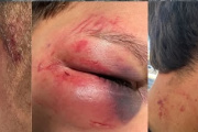 Un joven fue brutalmente golpeado a la salida de un boliche de La Plata