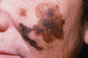 Una vacuna argentina “demostró activar una fuerte respuesta inmune contra el melanoma”, el cáncer de piel más agresivo
