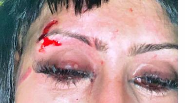 Una joven de La Plata fue a bailar con una amiga y fue víctima de un brutal ataque por parte de otra chica