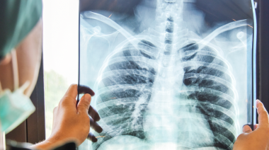 El último el informe global sobre Tuberculosis de la OMS generó preocupación en la comunidad médica