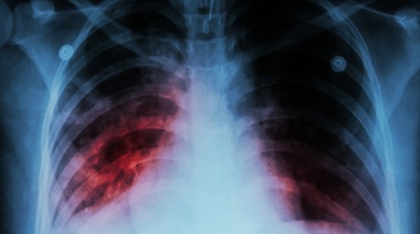 Detectaron un caso de tuberculosis en el Colegio "Albert Thomas" de La Plata
