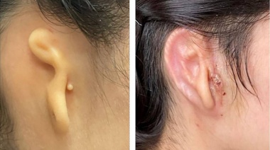 Por primera vez en la historia de la medicina trasplantaron una oreja impresa en 3D con células humanas