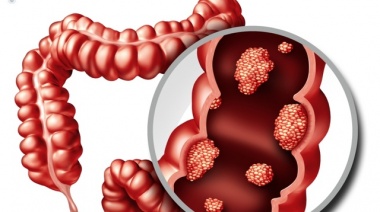 Investigadores descubrieron un nuevo gen clave para el crecimiento del cáncer de colon que podría ser el objetivo de terapias anticancerígenas