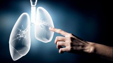 Apuestan a aumentar el diagnóstico temprano de cáncer de pulmón