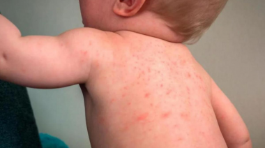 Kreplak: “Estamos atravesando la epidemia de dengue más grande de la historia del país"