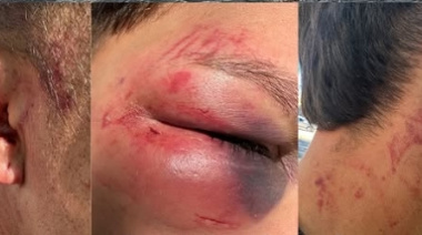 Un joven fue brutalmente golpeado a la salida de un boliche de La Plata