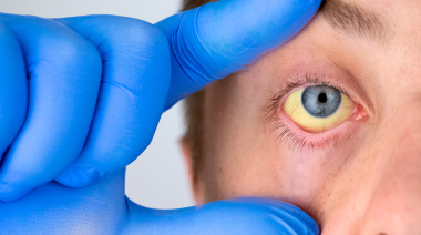 Un vecino de La Plata falleció por leptospirosis