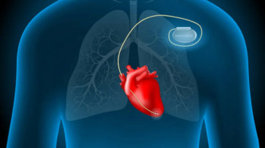 El Hospital Rossi de La Plata forma parte de la elaboración de un marcapasos que mejorará el tratamiento de las enfermedades cardiovasculares