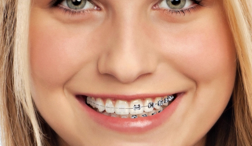 ¿Cuál es el precio aproximado de brackets? Info Blanco Sobre Negro